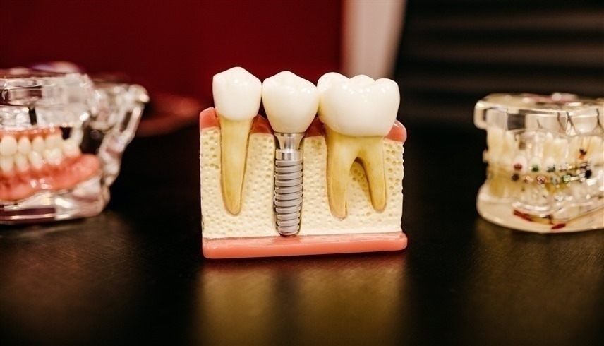استبدال الأسنان المفقودة بأطراف صناعية يحمي من التدهور المعرفي وأمراض القلب