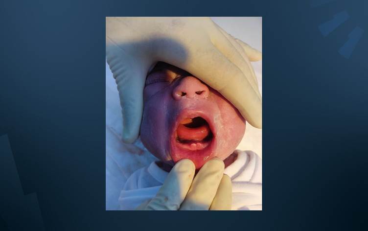 ولادة طفل بحالة طبية نادرة في مستشفى وسط العراق