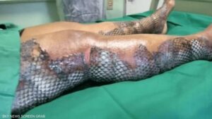 صورة لا تصدق لحروق امرأة.. الضماد الطبي حولها لسمكة اللصاقات مصنوعة من جلد سمك البلطي