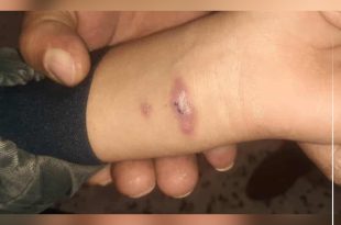 ظهور إصابات بمرض اللشمانيا في الهيرة