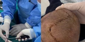 ميلاد جديد لرأس طفل : قصة نجاح ملهمة في مستشفى الحروق والتجميل
