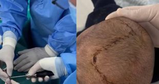 ميلاد جديد لرأس طفل :  قصة نجاح ملهمة  في مستشفى الحروق والتجميل