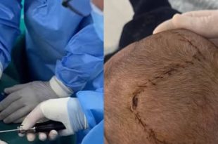 ميلاد جديد لرأس طفل :  قصة نجاح ملهمة  في مستشفى الحروق والتجميل