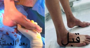 نجاح جراحة لطفل يعاني من تشوّه واعوجاج في القدم اليمنى