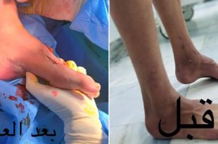 نجاح جراحة لطفل يعاني من تشوّه واعوجاج في القدم اليمنى