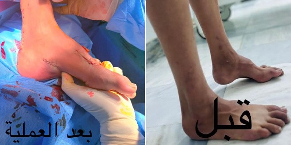 نجاح جراحة لطفل يعاني من تشوّه واعوجاج في القدم اليمنى