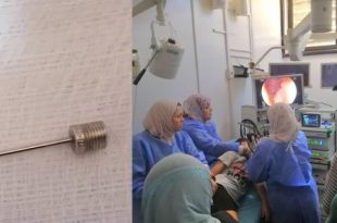 عملية ناجحة لاستخراج مسمار من معدة طفل أنقذ فريق طبي متخصص بقسم علاج أمراض الجهاز الهضمي والكبد والمناظير بالمستشفى الجامعي طرابلس، صباح اليوم الأربعاء ،حياة طفل يبلغ من العمر 11 عامًا، بعد ابتلاعه مسمار نفخ إطارات السيارات. وأوضح المكتب الاعلامي في المستشفى بأن حالة الطفل استدعت تدخلاً فوريًا، حيث قرر الأطباء إجراء عملية منظار علوي دقيقة وعاجلة لاستخراج المسمار من الإثنى عشر، وسط ظروف دقيقة تتطلب دقة وسرعة استجابة. أُجريت العملية تحت التخدير الكامل و استمرت 30 دقيقة، وتكللت بالنجاح دون تسجيل أي مضاعفات، حيث نُقل الطفل بعدها إلى القسم لمتابعته من قبل الفريق الطبي، قبل منحه إذن مغادرة بعد استقرار حالته الصحية.