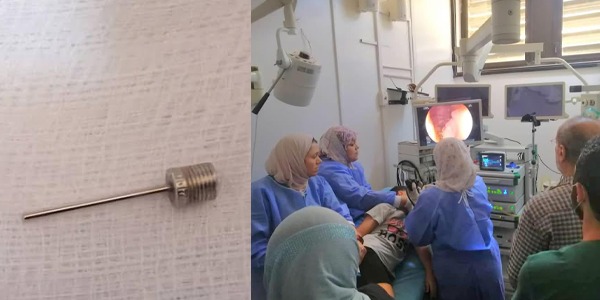 عملية ناجحة لاستخراج مسمار من معدة طفل أنقذ فريق طبي متخصص بقسم علاج أمراض الجهاز الهضمي والكبد والمناظير بالمستشفى الجامعي طرابلس، صباح اليوم الأربعاء ،حياة طفل يبلغ من العمر 11 عامًا، بعد ابتلاعه مسمار نفخ إطارات السيارات. وأوضح المكتب الاعلامي في المستشفى بأن حالة الطفل استدعت تدخلاً فوريًا، حيث قرر الأطباء إجراء عملية منظار علوي دقيقة وعاجلة لاستخراج المسمار من الإثنى عشر، وسط ظروف دقيقة تتطلب دقة وسرعة استجابة. أُجريت العملية تحت التخدير الكامل و استمرت 30 دقيقة، وتكللت بالنجاح دون تسجيل أي مضاعفات، حيث نُقل الطفل بعدها إلى القسم لمتابعته من قبل الفريق الطبي، قبل منحه إذن مغادرة بعد استقرار حالته الصحية.