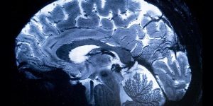 الصين تنجح في أول تجربة لزرع شريحة دماغية للتحكم بالأجهزة عبر التفكير