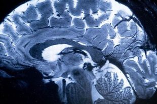 الصين تنجح في أول تجربة لزرع شريحة دماغية للتحكم بالأجهزة عبر التفكير