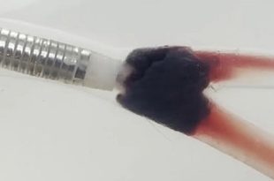 ابتكار جهاز لإزالة الجلطات الدموية من الجسم