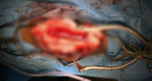 عملية جراحية تنقذ شابًا من شلل تام في مركز بنغازي الطبي