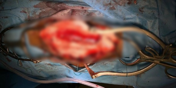 عملية جراحية تنقذ شابًا من شلل تام في مركز بنغازي الطبي