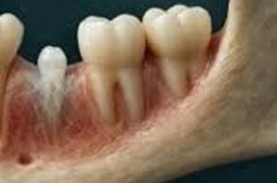 شركة يابانية تعمل على أول دواء في العالم لانبات أسنان جديدة