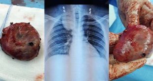 فريق طبي ليبي ينجح في استئصال ورم عصبي بجراحة محدودة