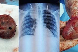 فريق طبي ليبي ينجح في استئصال ورم عصبي بجراحة محدودة