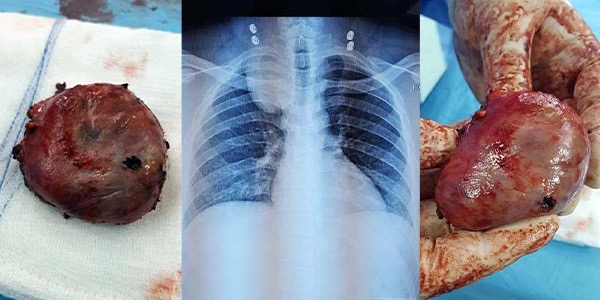 فريق طبي ليبي ينجح في استئصال ورم عصبي بجراحة محدودة