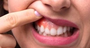 مركز علاج السكري يستعد لاستقبال حالات أمراض اللثة المصابة بالسكري