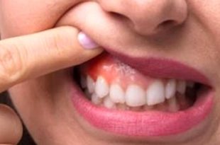 مركز علاج السكري يستعد لاستقبال حالات أمراض اللثة المصابة بالسكري