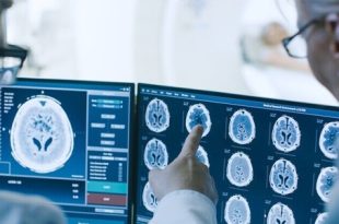 اكتشاف علمي: جين Shootin1b يسرّع انتشار سرطان الدماغ 