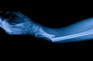 علماء صينيون يبتكرون لاصقاً طبياً يسرع التئام الكسور خلال دقائق