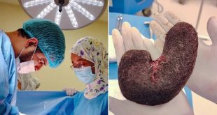 نجاح عملية لإزالة كتل شعر من معدة مريضة بإجدابيا