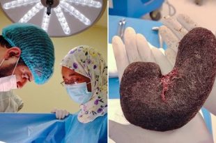 نجاح عملية لإزالة كتل شعر من معدة مريضة بإجدابيا