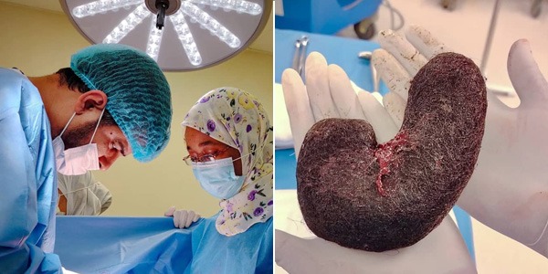 نجاح عملية لإزالة كتل شعر من معدة مريضة بإجدابيا