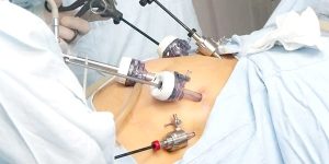 نسبة كبيرة من المقبلين على التكميم لا يعانون من سمنة مفرطة 