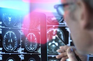 دواء لألزهايمر يحقق نتائج غير مسبوق ويُبطئ تطور المرض