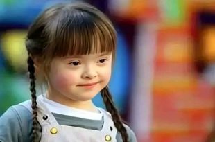 تقنية حديثة تنجح في فصل مُتسبب متلازمة "داون"