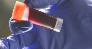 علماء يكتشفون علاقة بين فصيلة الدم والسكتة الدماغية المبكرة