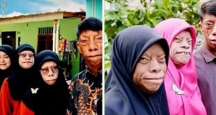 اضطراب وراثي نادر يغيّر ملامح الوجه ولا يؤثر عقليًا