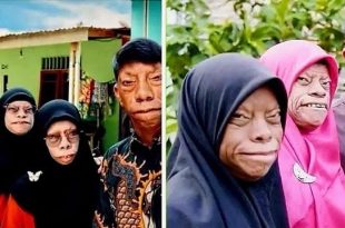 اضطراب وراثي نادر يغيّر ملامح الوجه ولا يؤثر عقليًا