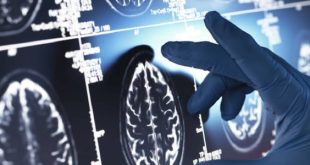 آفاق جديدة لعلاج الزهايمر واستعادة الذاكرة