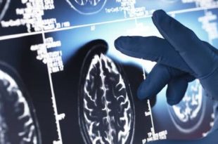 آفاق جديدة لعلاج الزهايمر واستعادة الذاكرة