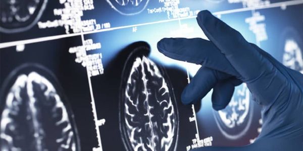 آفاق جديدة لعلاج الزهايمر واستعادة الذاكرة
