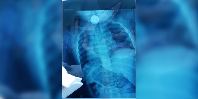 صورة أشعة سينية باللونين الأزرق والأبيض لمنطقة الصدر والرقبة لطفل، يظهر فيها بوضوح جسم دائري معدني لامع مستقر في الجزء العلوي من المجرى (منطقة المريء/البلعوم).