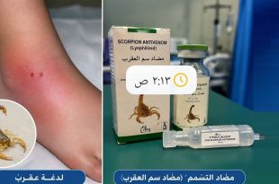 صورة توضح عبوات مضاد سم العقرب بجانب أثر لدغة عقرب على القدم، تعبيرًا عن استقبال مستشفى يفرن العام إصابات بلدغات العقارب
