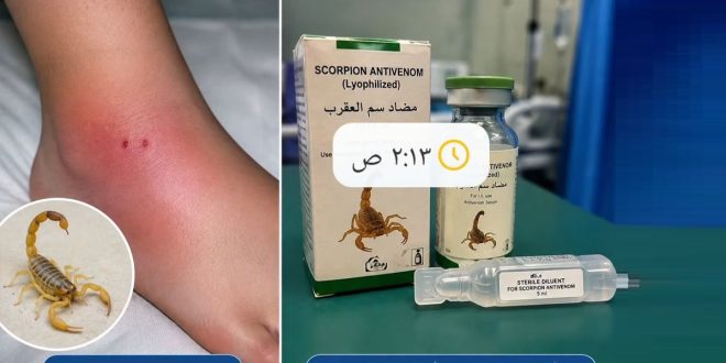 صورة توضح عبوات مضاد سم العقرب بجانب أثر لدغة عقرب على القدم، تعبيرًا عن استقبال مستشفى يفرن العام إصابات بلدغات العقارب